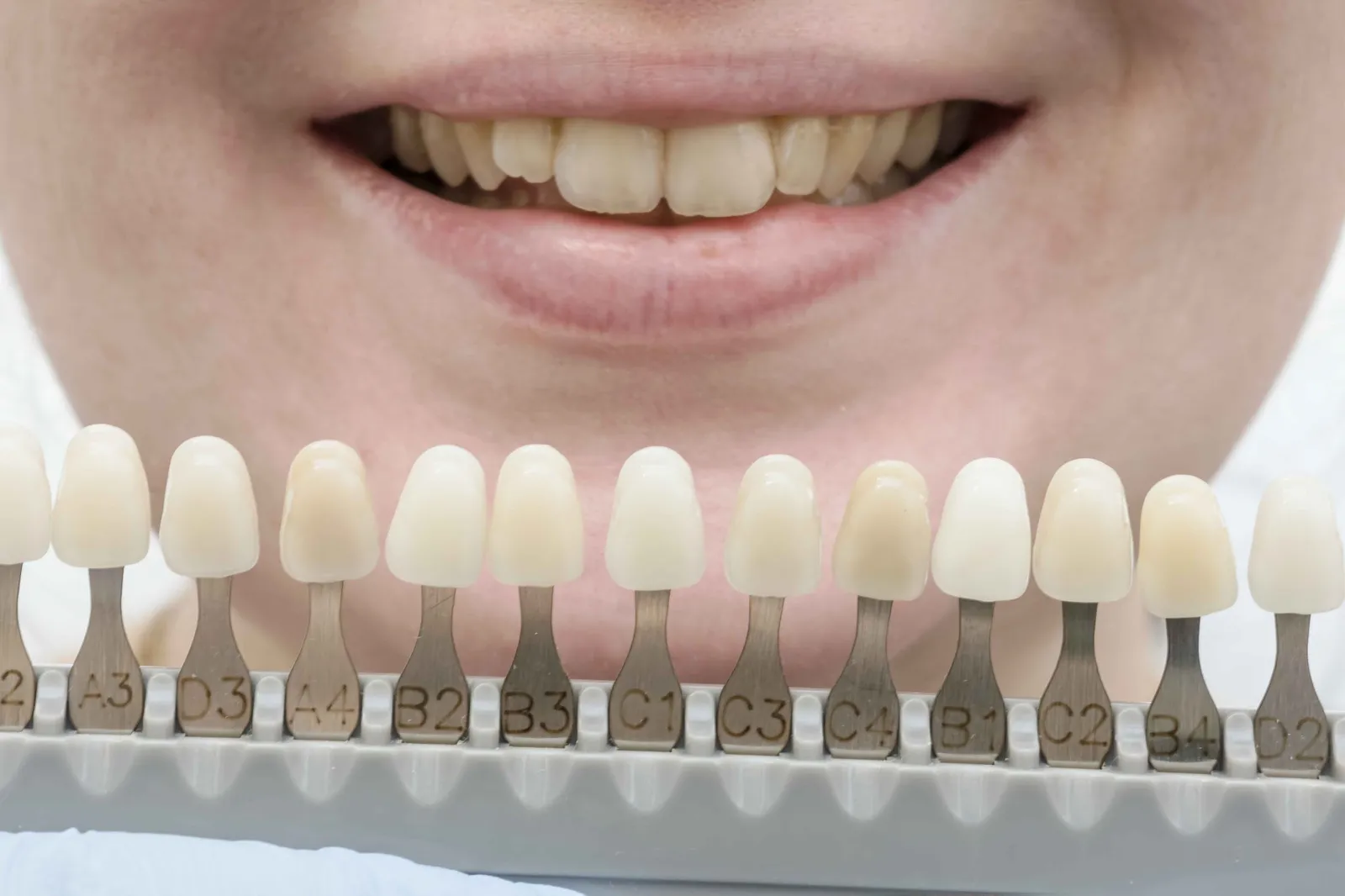 Dental shade guide being used to compare the colour of a patient's natural teeth