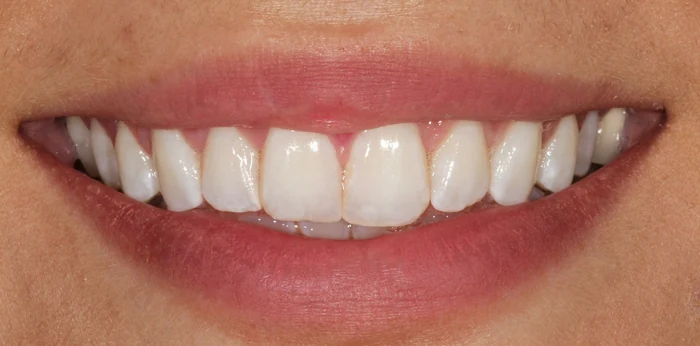 Composite bonding before at Hacton Dental Care