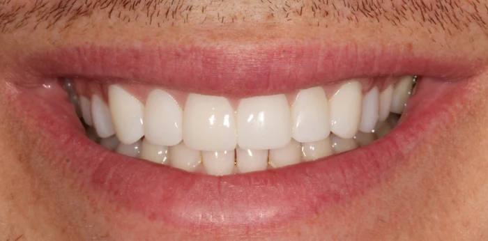 Composite bonding after at Hacton Dental Care