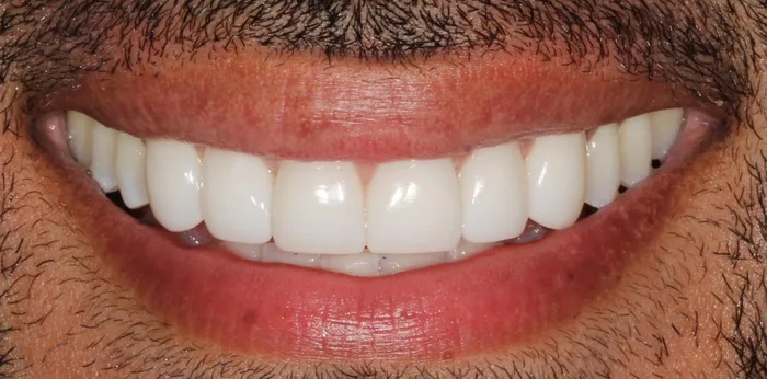 After composite bonding treatment at Hacton Dental Care, Hornchurch