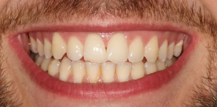 Before composite bonding treatment at Hacton Dental Care, Hornchurch