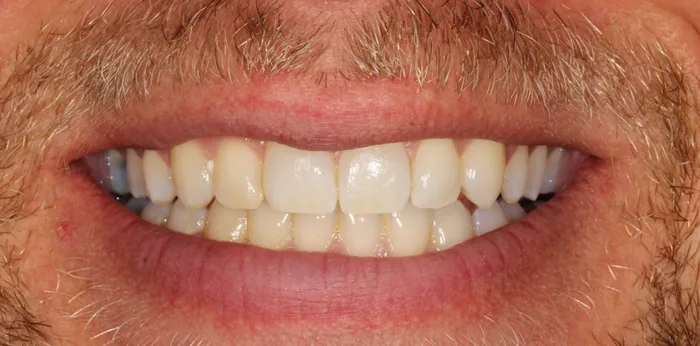 Before composite bonding treatment at Hacton Dental Care, Hornchurch