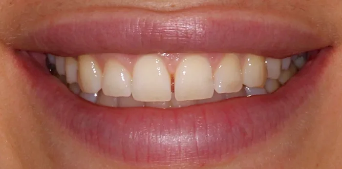 Before composite bonding treatment at Hacton Dental Care, Hornchurch