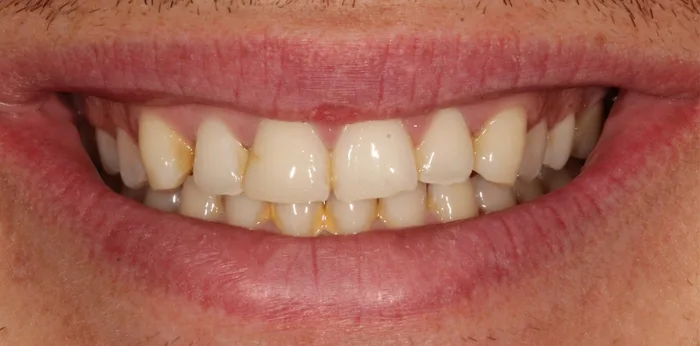 Before composite bonding treatment at Hacton Dental Care, Hornchurch