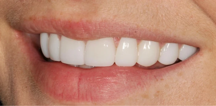 After smile makeover treatment at Hacton Dental Care, Hornchurch