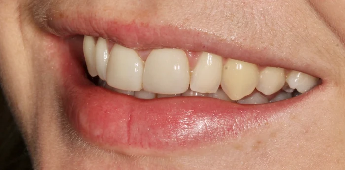Before smile makeover treatment at Hacton Dental Care, Hornchurch