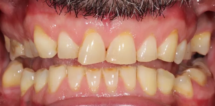 Before porcelain veneers treatment at Hacton Dental Care, Hornchurch