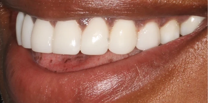 After smile makeover treatment at Hacton Dental Care, Hornchurch