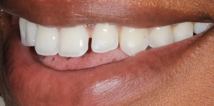 Before smile makeover treatment at Hacton Dental Care, Hornchurch