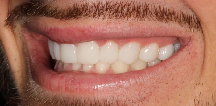 After smile makeover treatment at Hacton Dental Care, Hornchurch