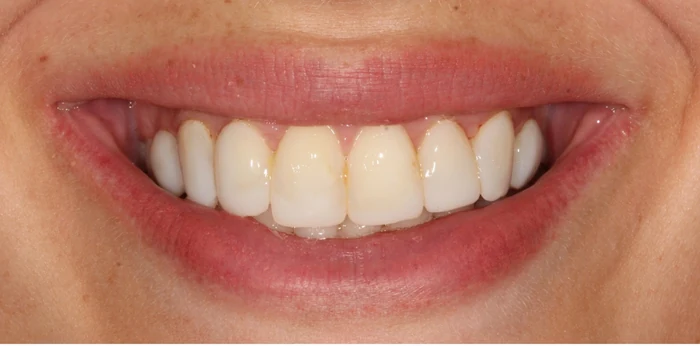 Before smile makeover treatment at Hacton Dental Care, Hornchurch