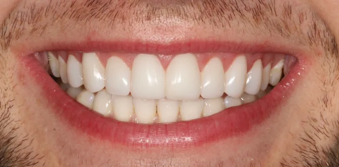 After teeth whitening treatment at Hacton Dental Care, Hornchurch